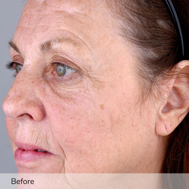 A woman's face before using the Elevare Plus + device in a clinical trial