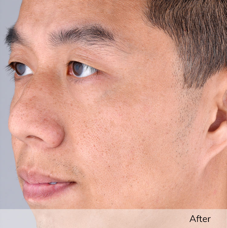 A man's face after using the Elevare Plus + device in a clinical trial