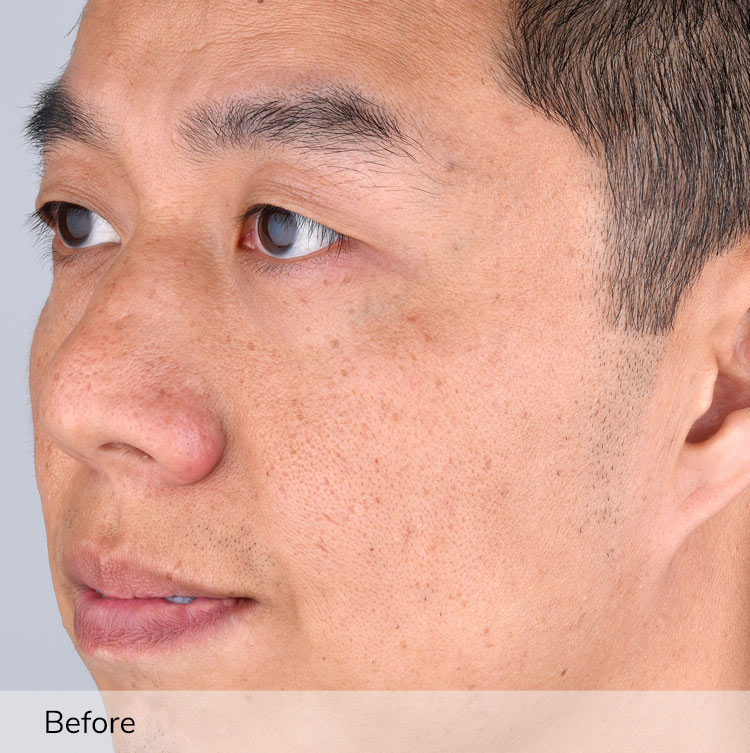 A man's face before using the Elevare Plus + device in a clinical trial