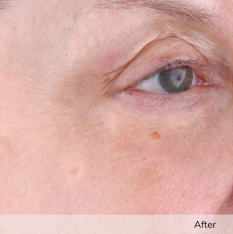 A woman's face, focusing on the area around the eye, after using the Elevare Plus + device in a clinical trial