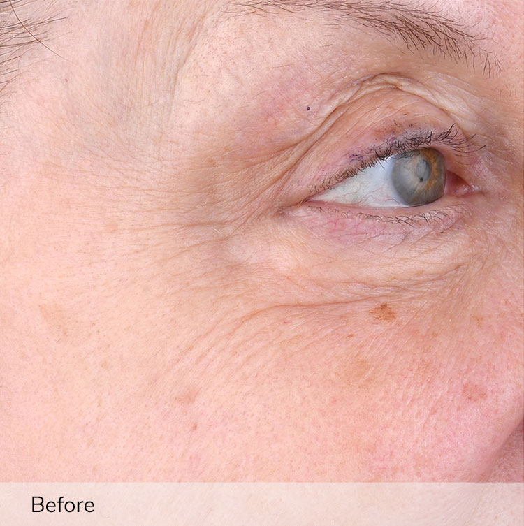 A woman's face, focusing on the area around the eye, before using the Elevare Plus + device in a clinical trial