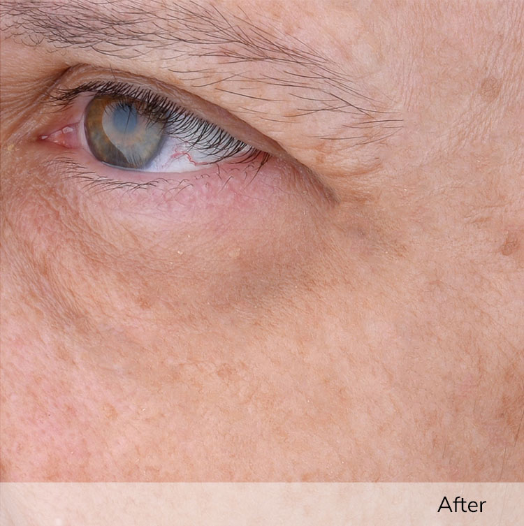 A person's face, focusing on the area around the eye, after using the Elevare Plus + device in a clinical trial