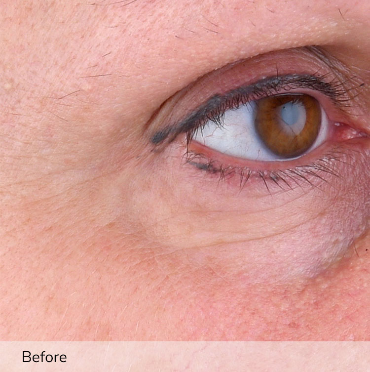A woman's face, focusing on the area around the eye, before using the Elevare Plus + device in a clinical trial