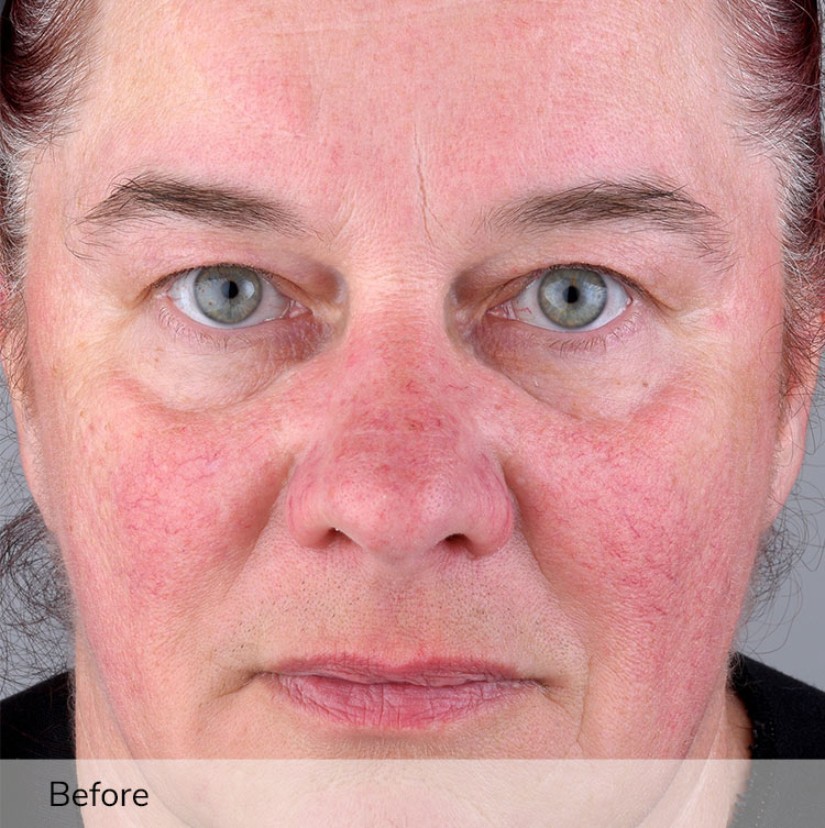 A woman's face before using the Elevare Plus + device in a clinical trial