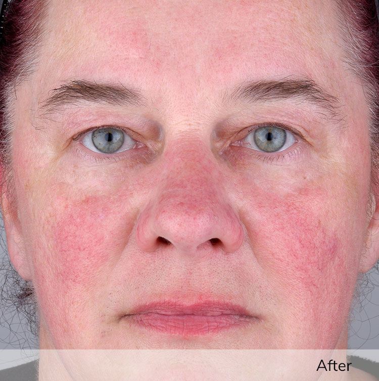 A woman's face after using the Elevare Plus + device in a clinical trial