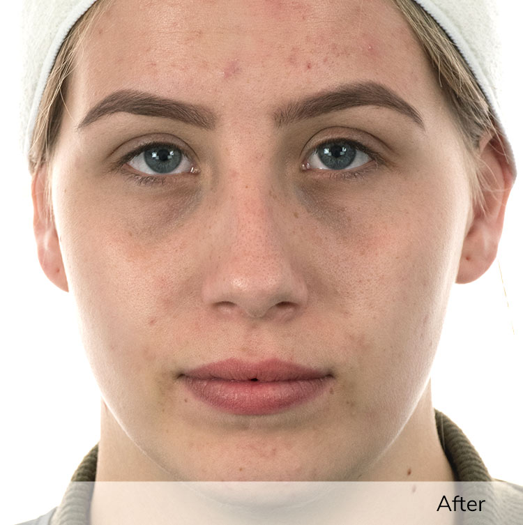 A woman's face after using the Ivory device in a clinical trial