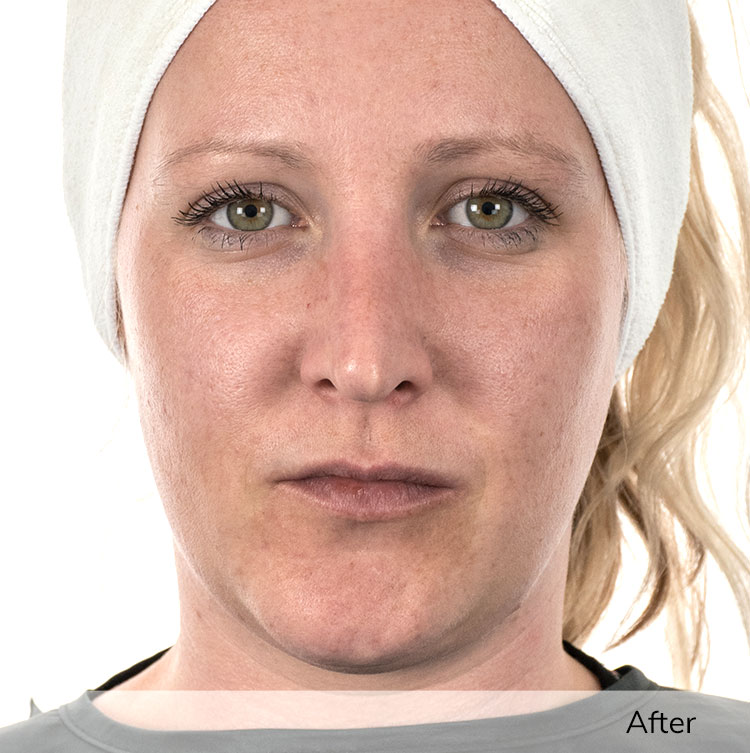 A woman's face after using the Ivory device in a clinical trial