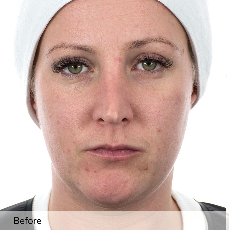 A woman's face before using the Ivory device in a clinical trial