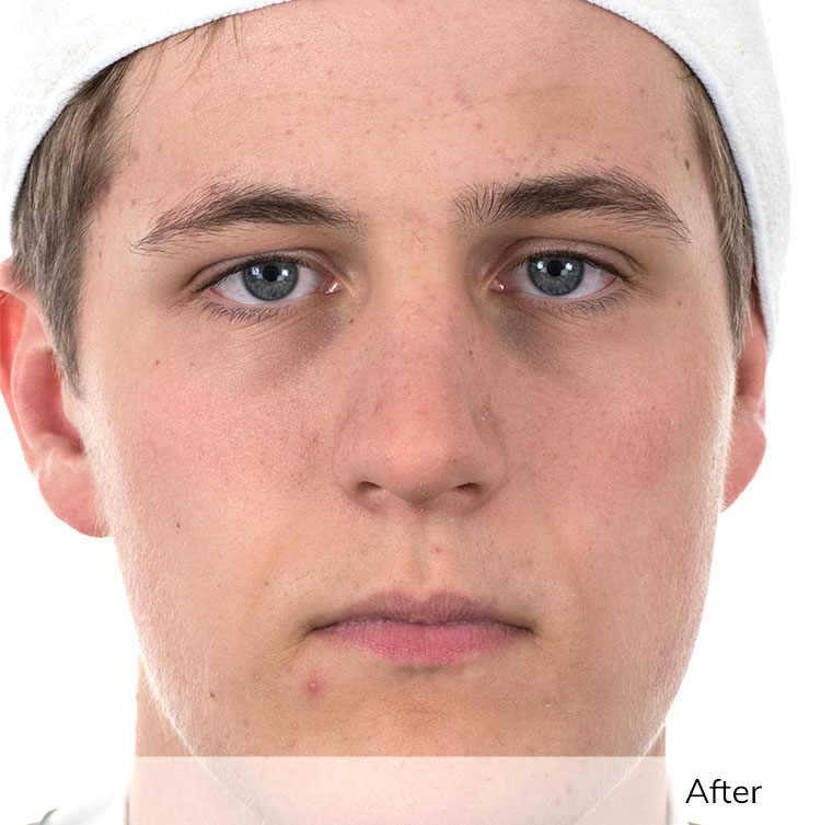 A man's face after using the Ivory device in a clinical trial