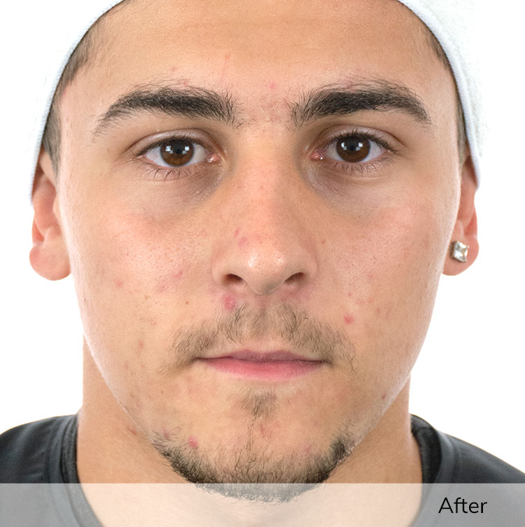 A man's face after using the Ivory device in a clinical trial