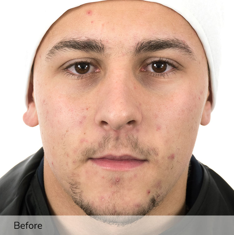 A man's face before using the Ivory device in a clinical trial